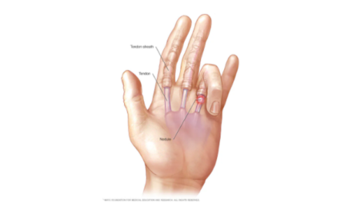 Ilustrasi trigger finger