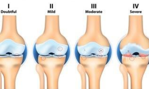 osteoarthritis