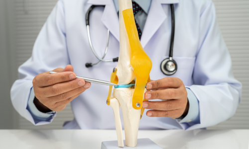Jangan Buru-Buru Operasi! Atasi Osteoarthritis atau Radang Sendi Lutut dan Kaku Tanpa Masuk Meja Operasi